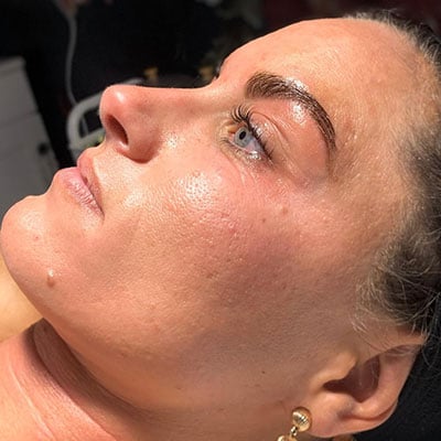 DERMAPLANE FACIALS